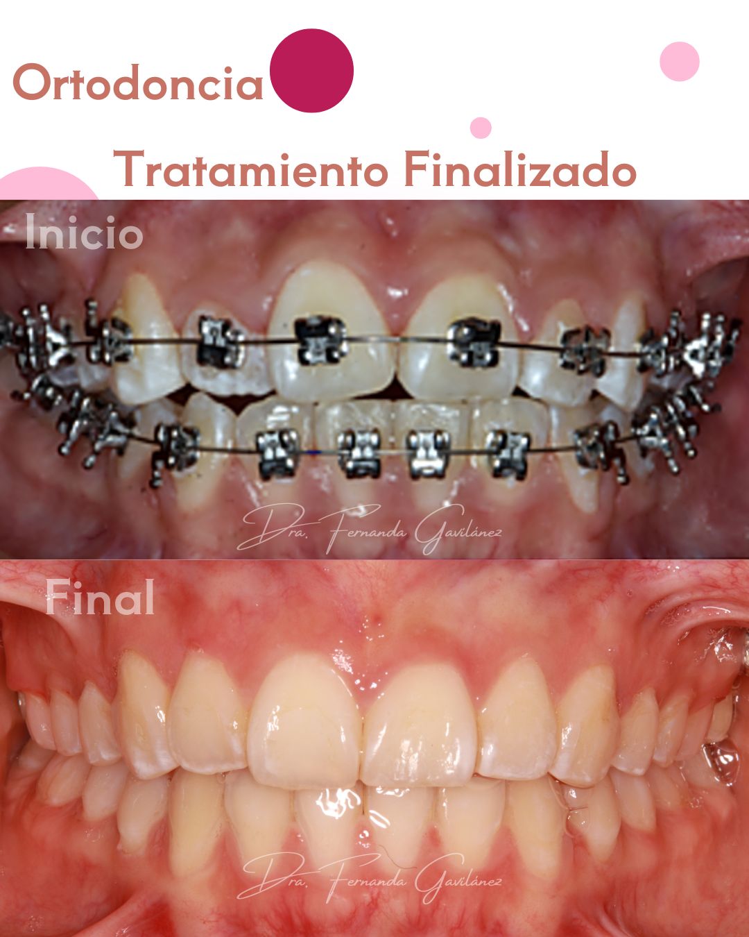 Antes y después - Caso 1