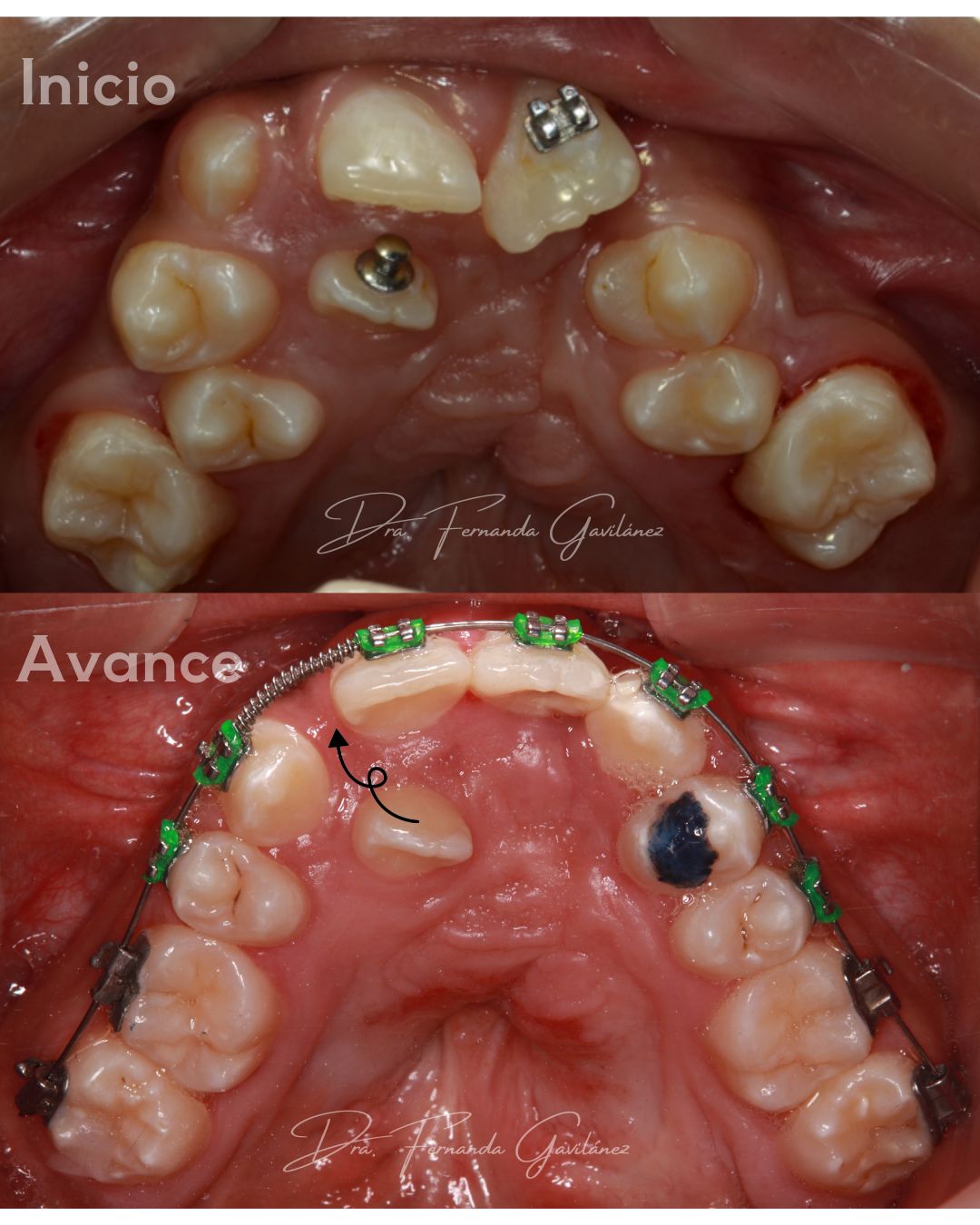 Antes y en proceso - Caso 2